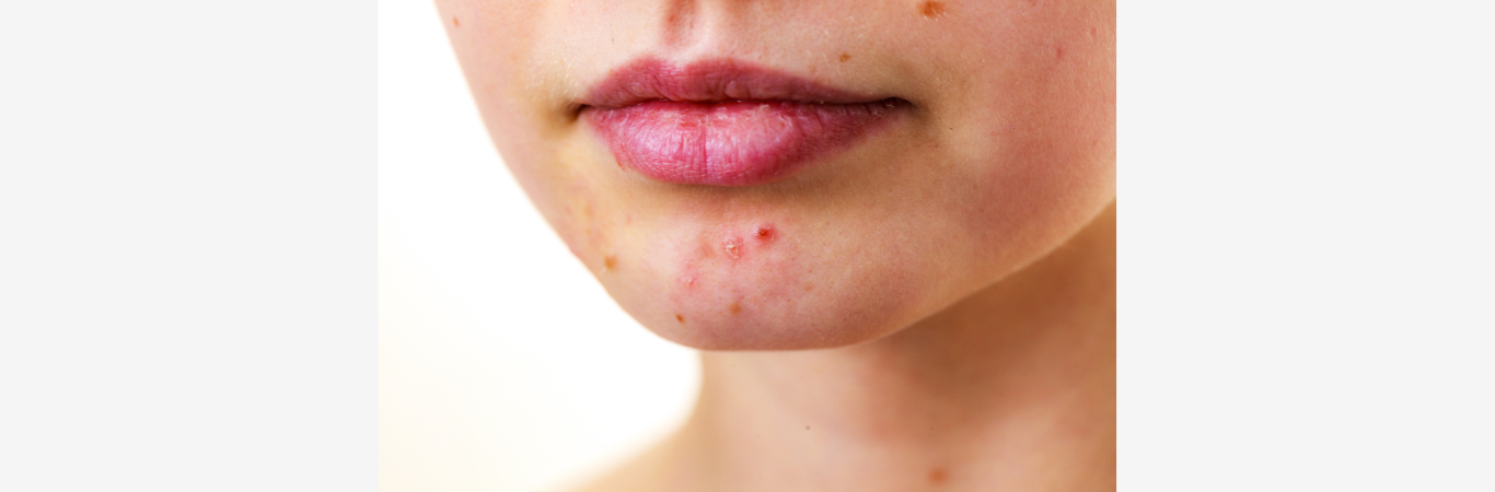 Commander roaccutane