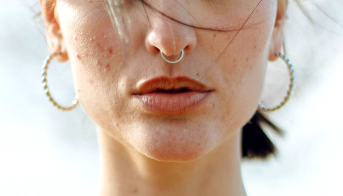 Accutane Online Italia