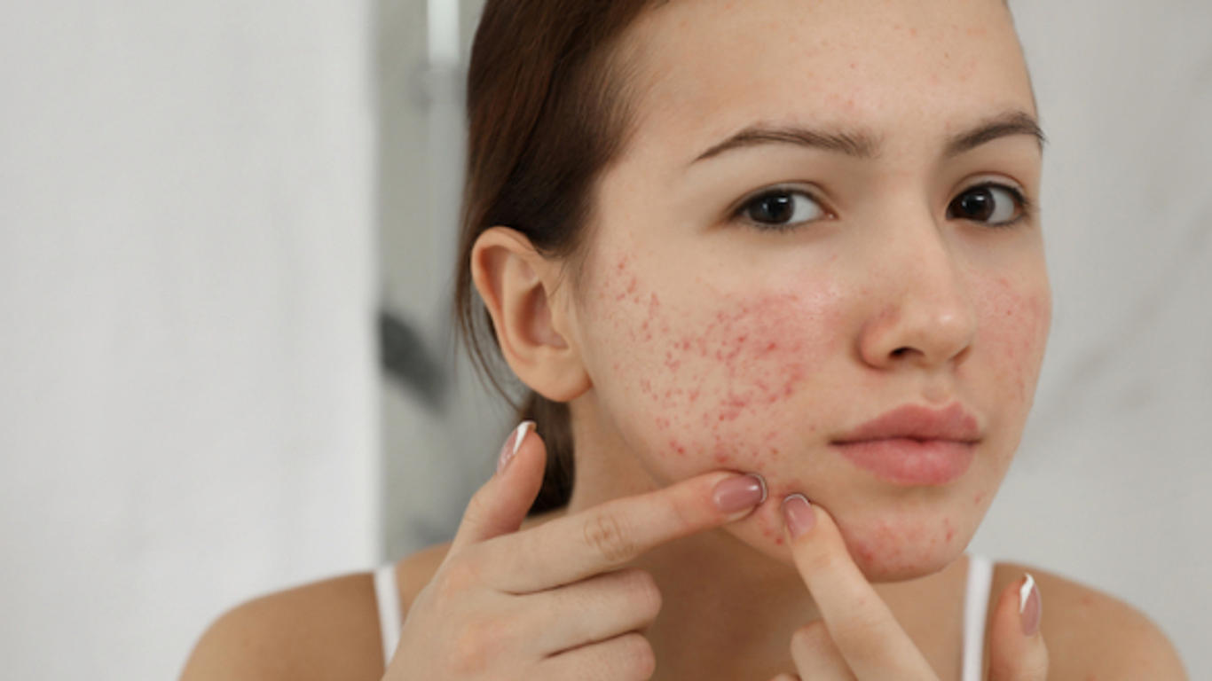 Roaccutane sans ordonnance