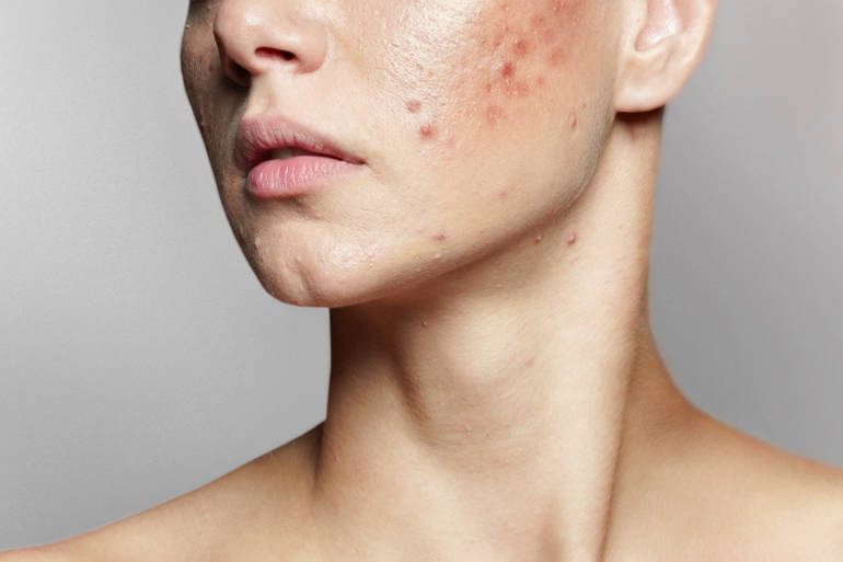 Pilule pour roaccutane