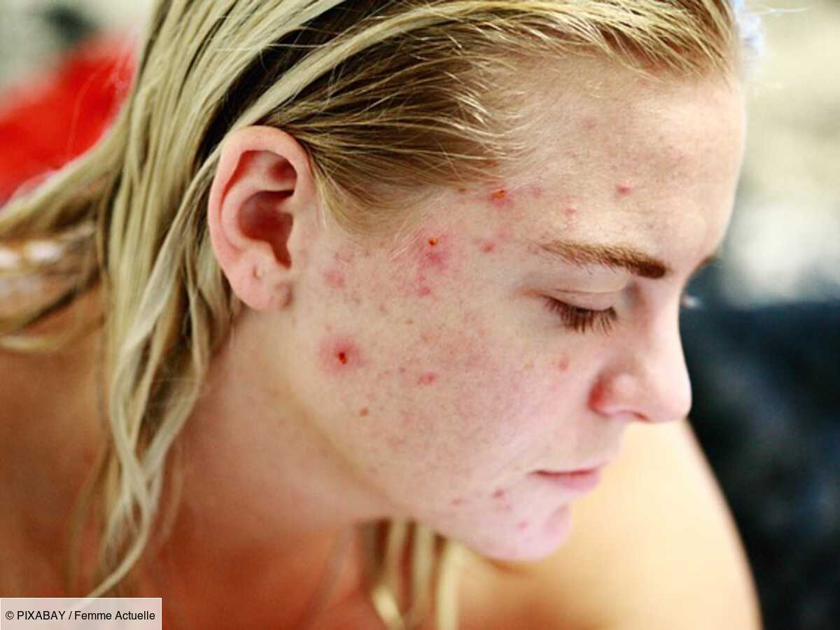 Roaccutane Prix Acné