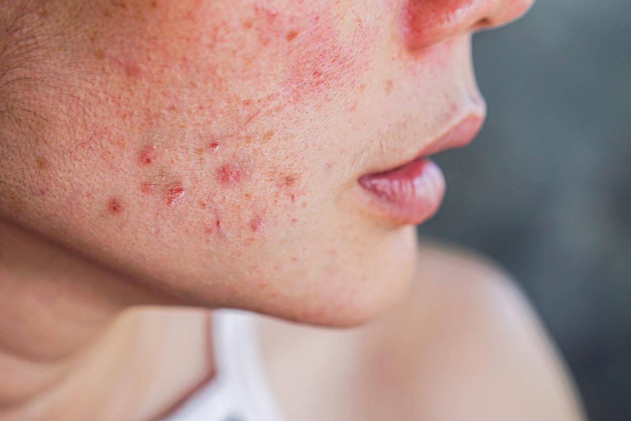 roaccutane bon marché