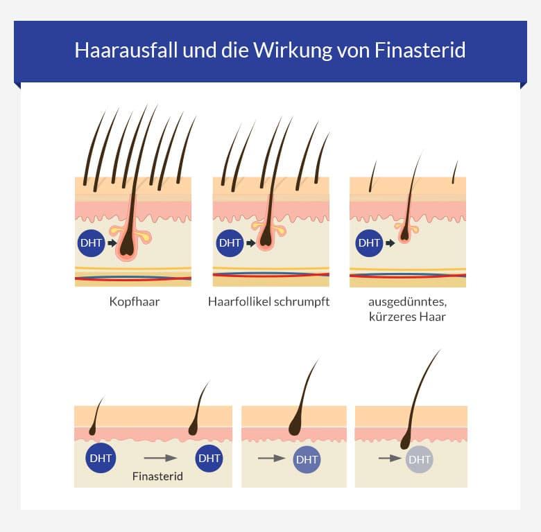 finasteride online europe