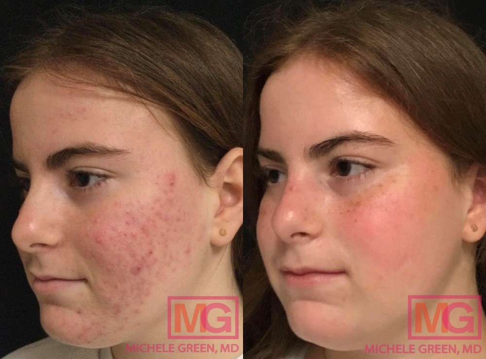 Coût Du Accutane