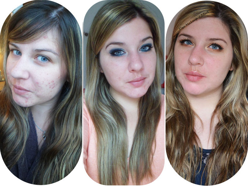 accutane prix