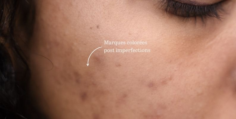 Pilule Sous Roaccutane