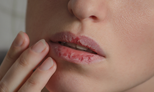 Ou acheter roaccutane