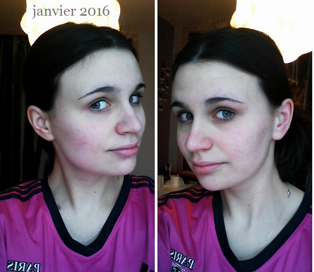 Roaccutane 20mg