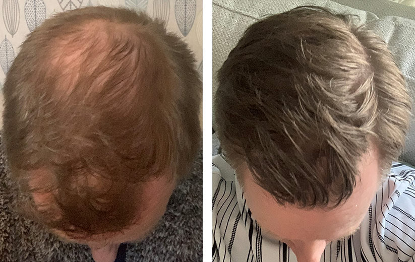 Finasteride achat france