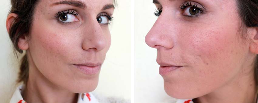 coût roaccutane