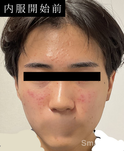 Isotretinoin Moins Cher