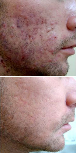Roaccutane Achat Internet