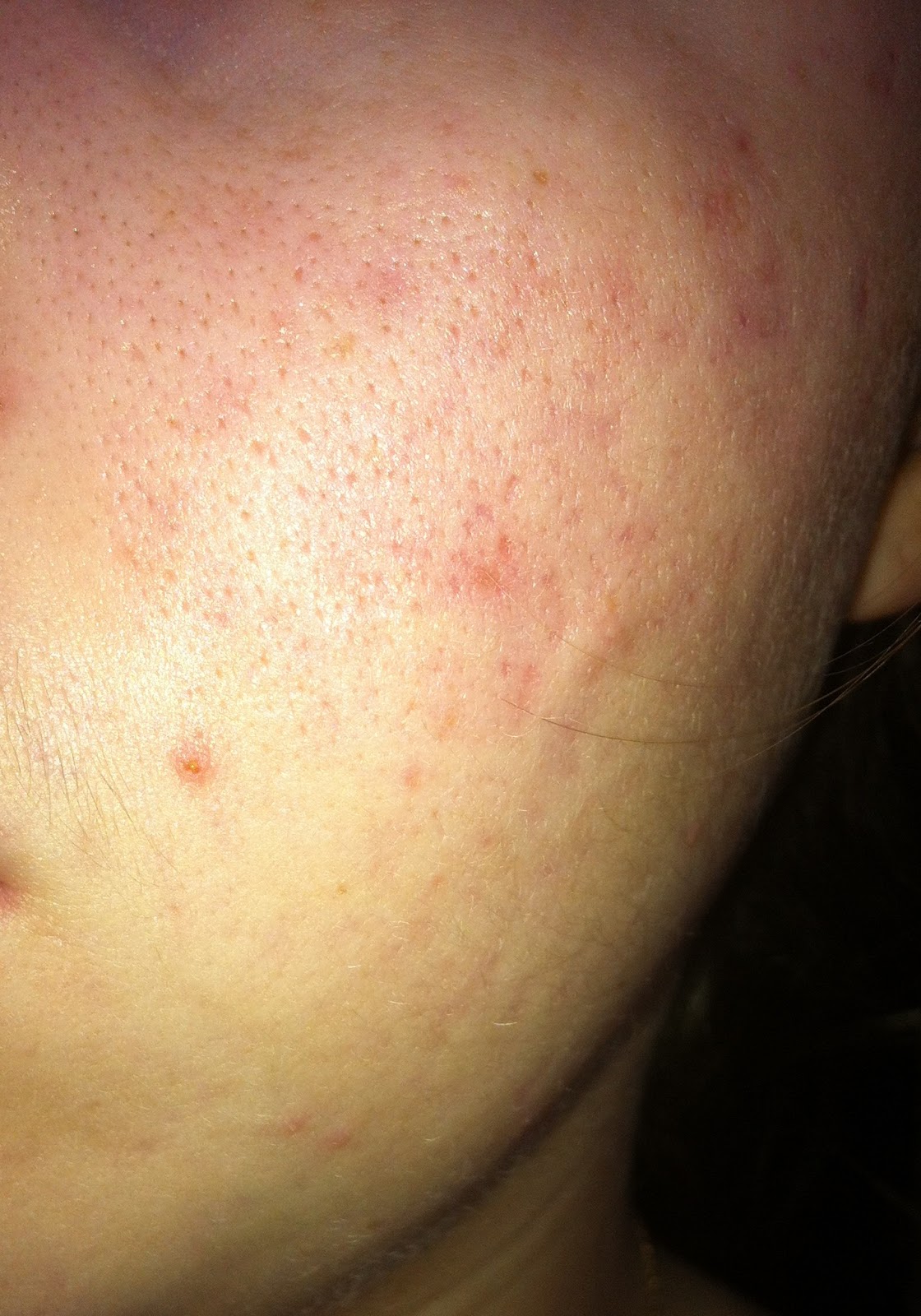 roaccutane cachet prix