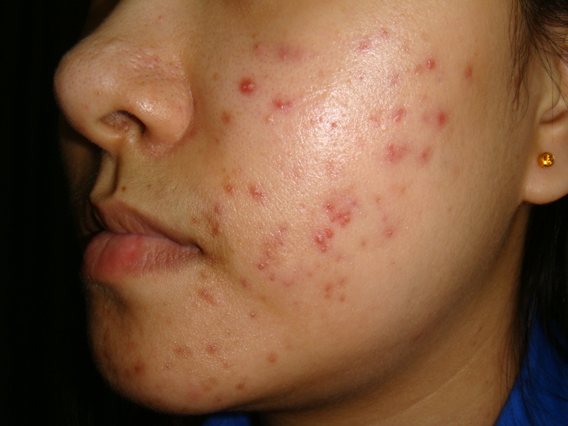 Ou Acheter Du Roaccutane