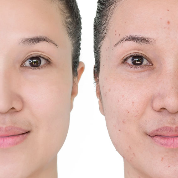 online dermatologist accutane