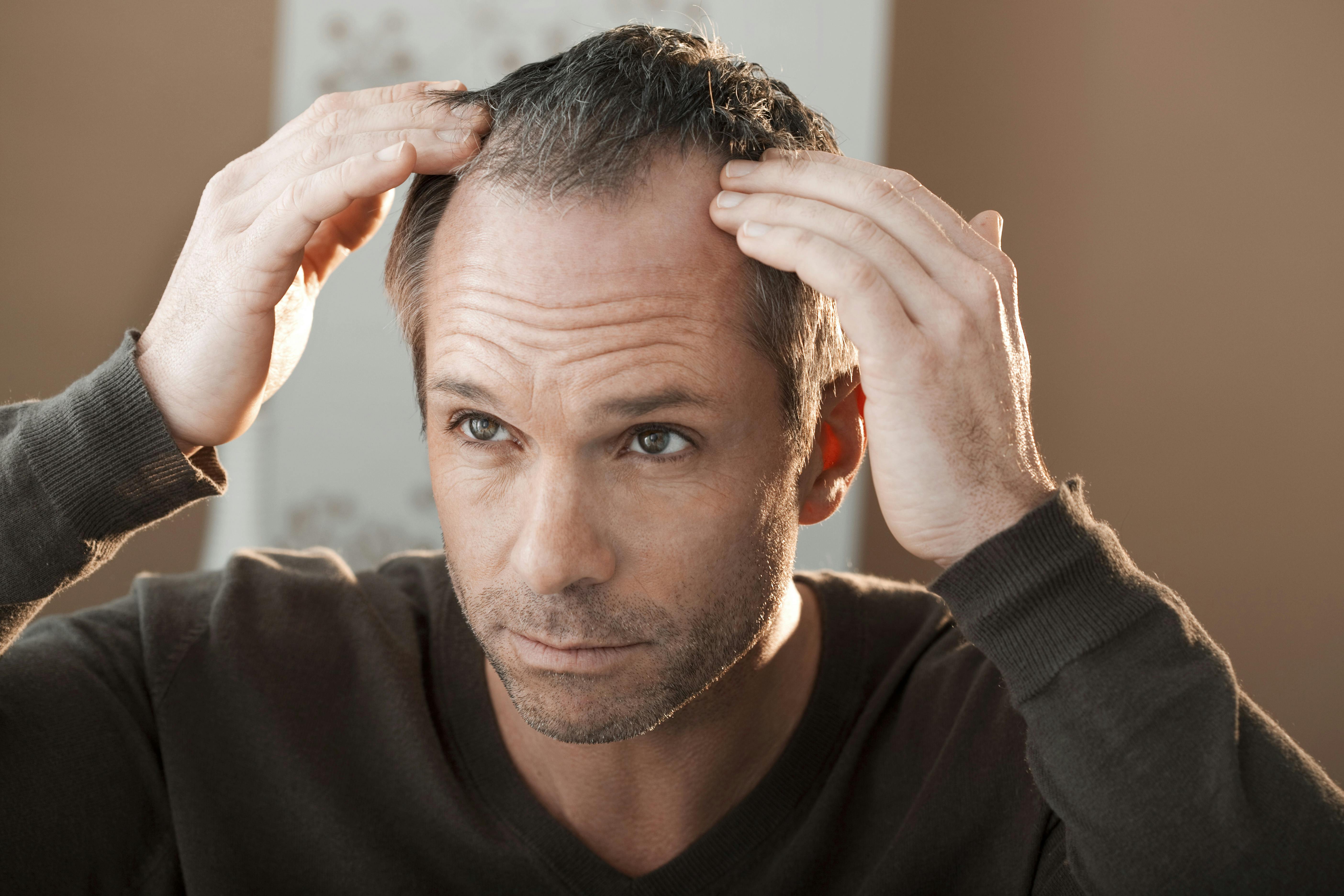 Acheter Du Finastéride