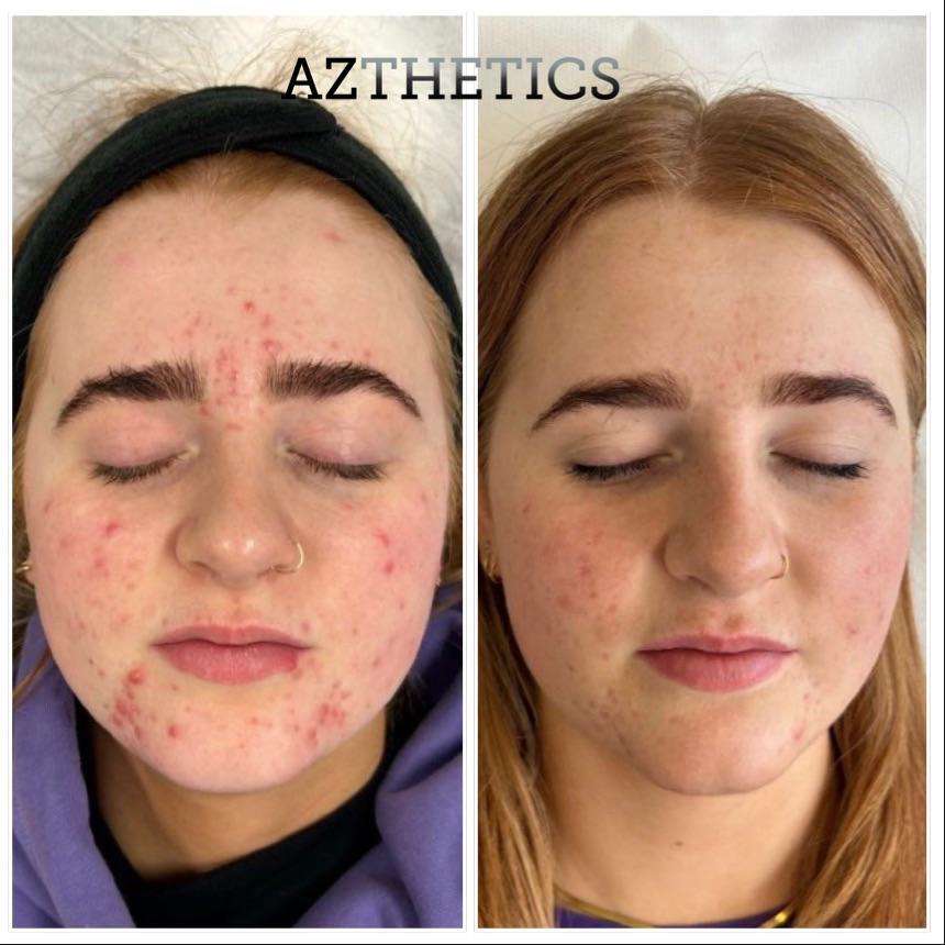 Roaccutane Acné Pilule