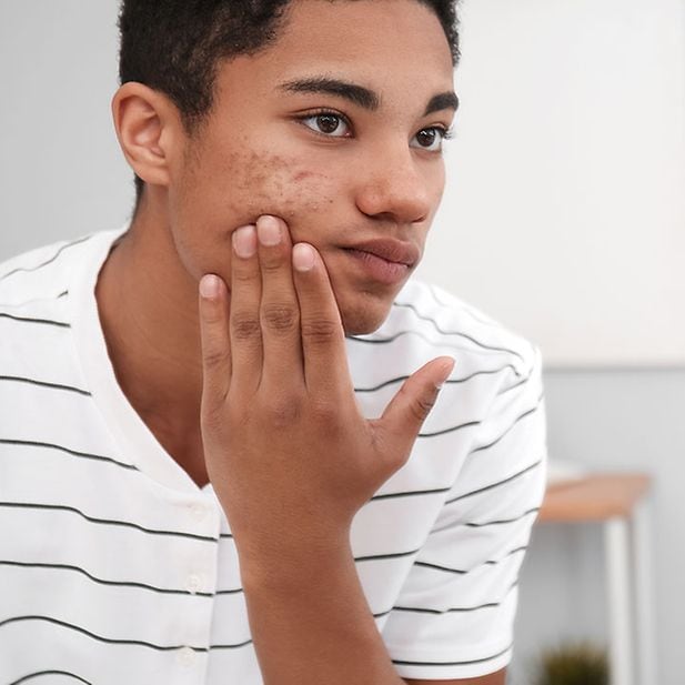 Prix pour roaccutane