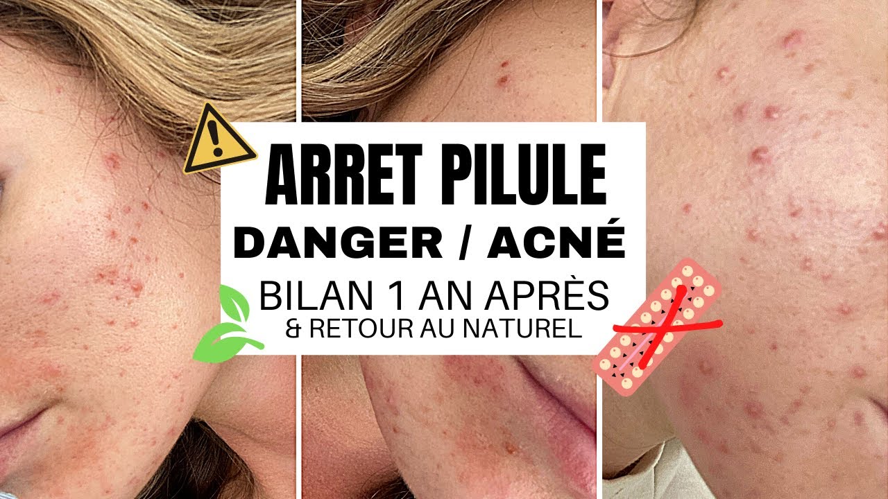 Peut On Avoir Accutane Sans Ordonnance