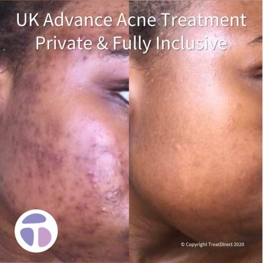 Roaccutane prix 2020