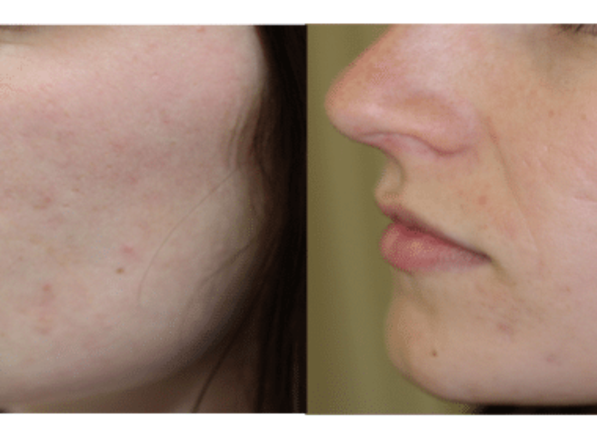 Prix isotretinoin