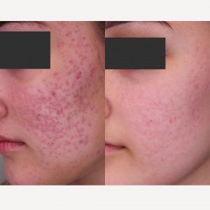 Ordre roaccutane
