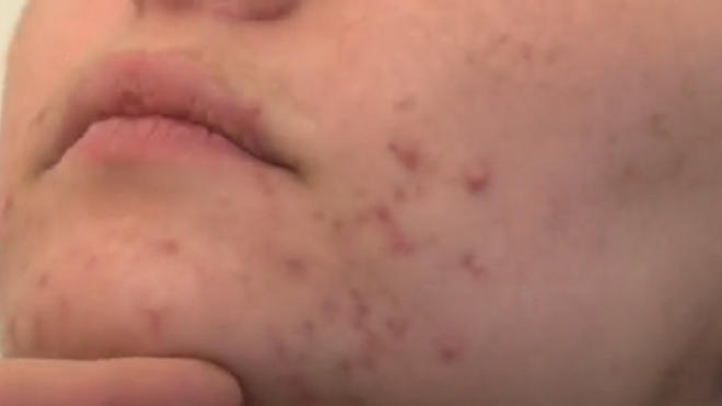 Roaccutane Arret Pilule