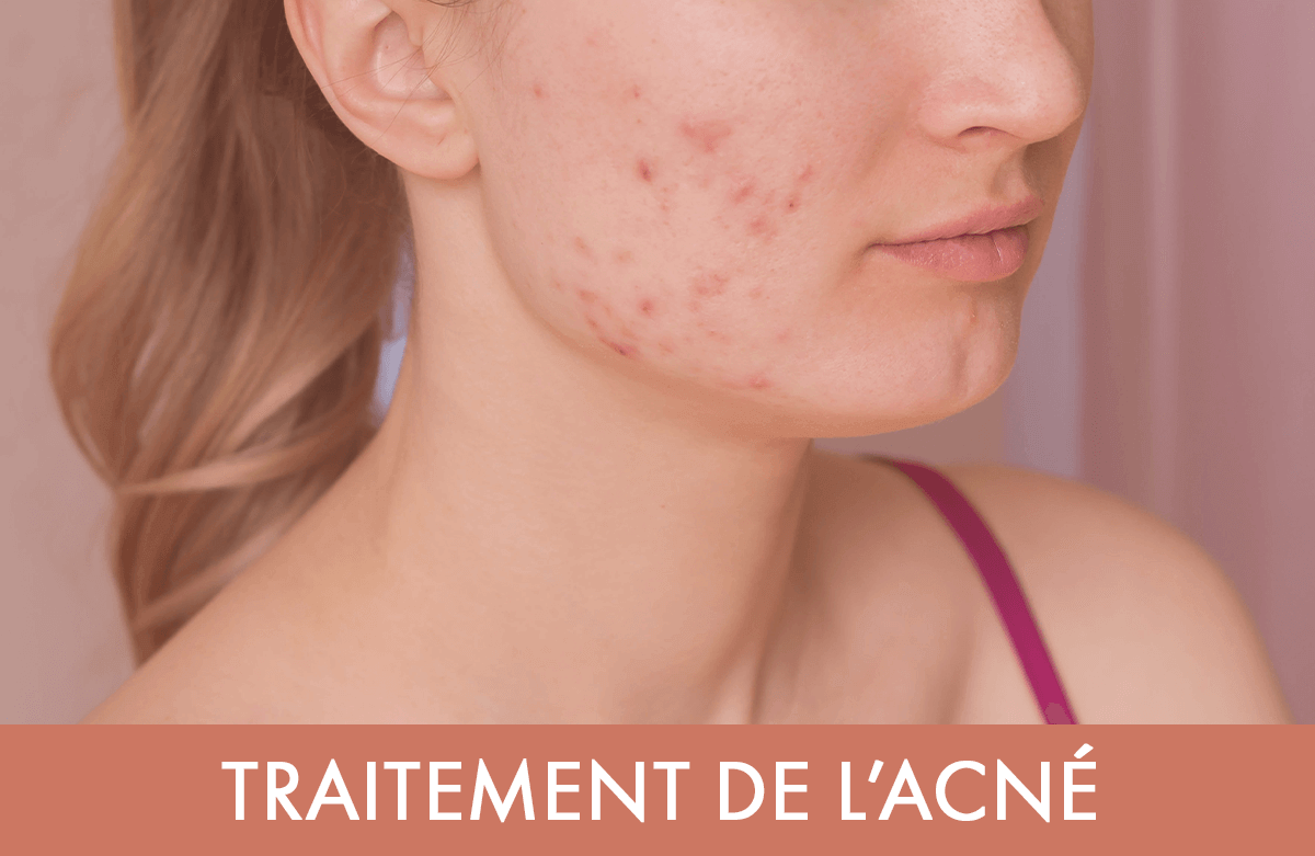 prix du traitement roaccutane