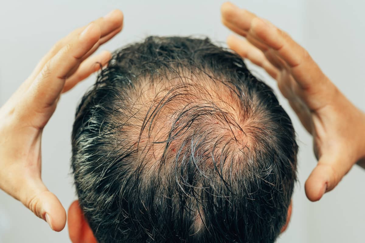 coût du finasteride