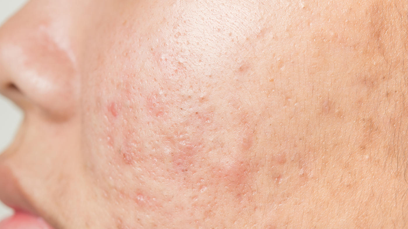Isotretinoin Où Acheter