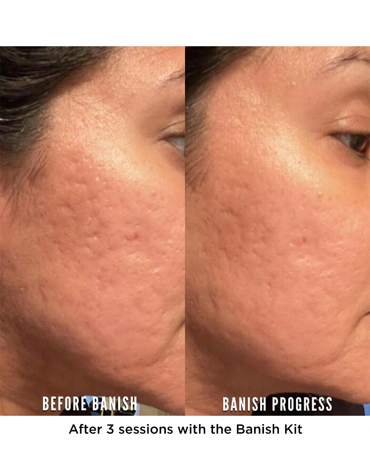 Accutane Moins Cher