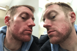 commander accutane