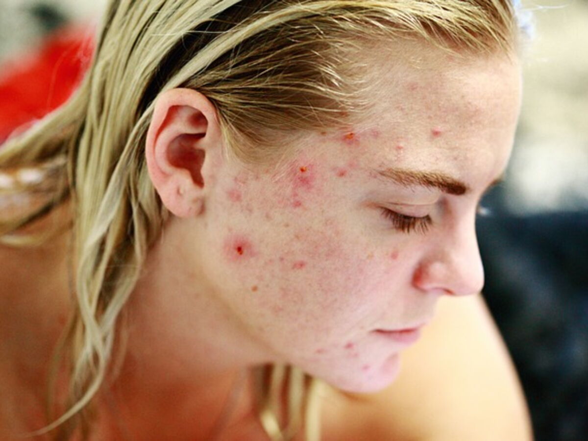 Accutane 5mg