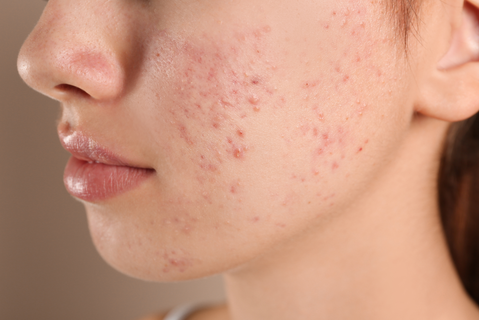 Commander du accutane
