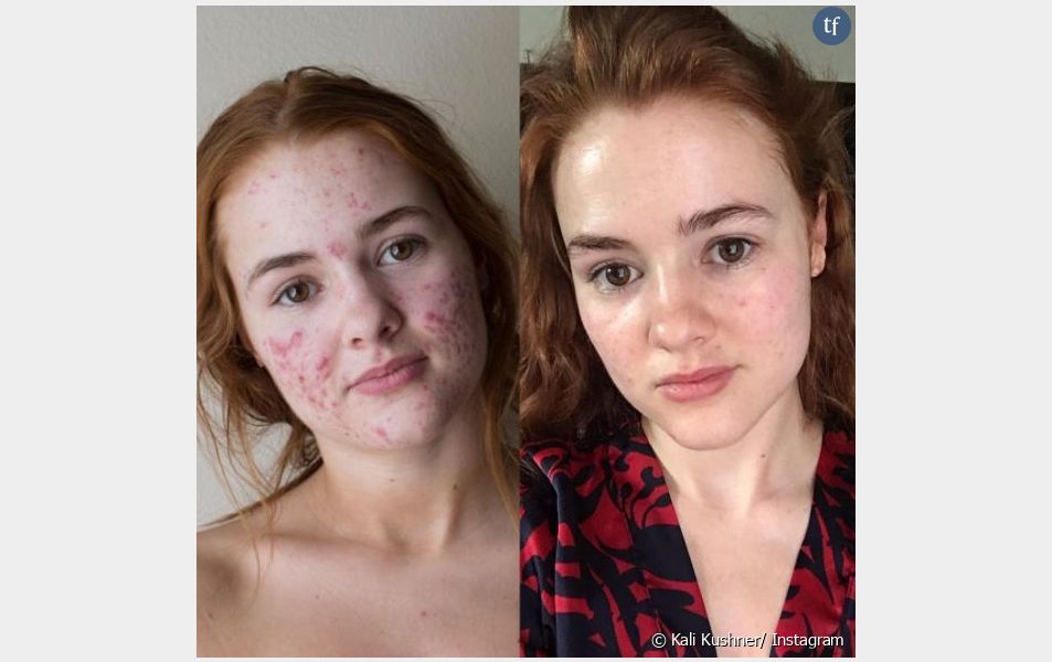 Roaccutane france