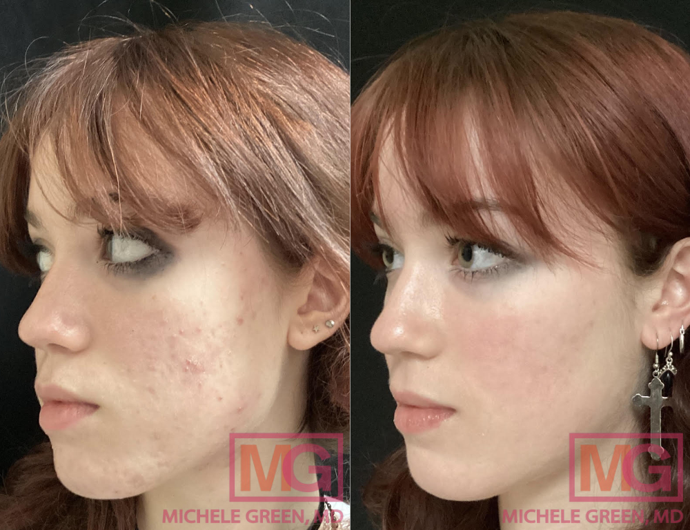 Commander Du Accutane