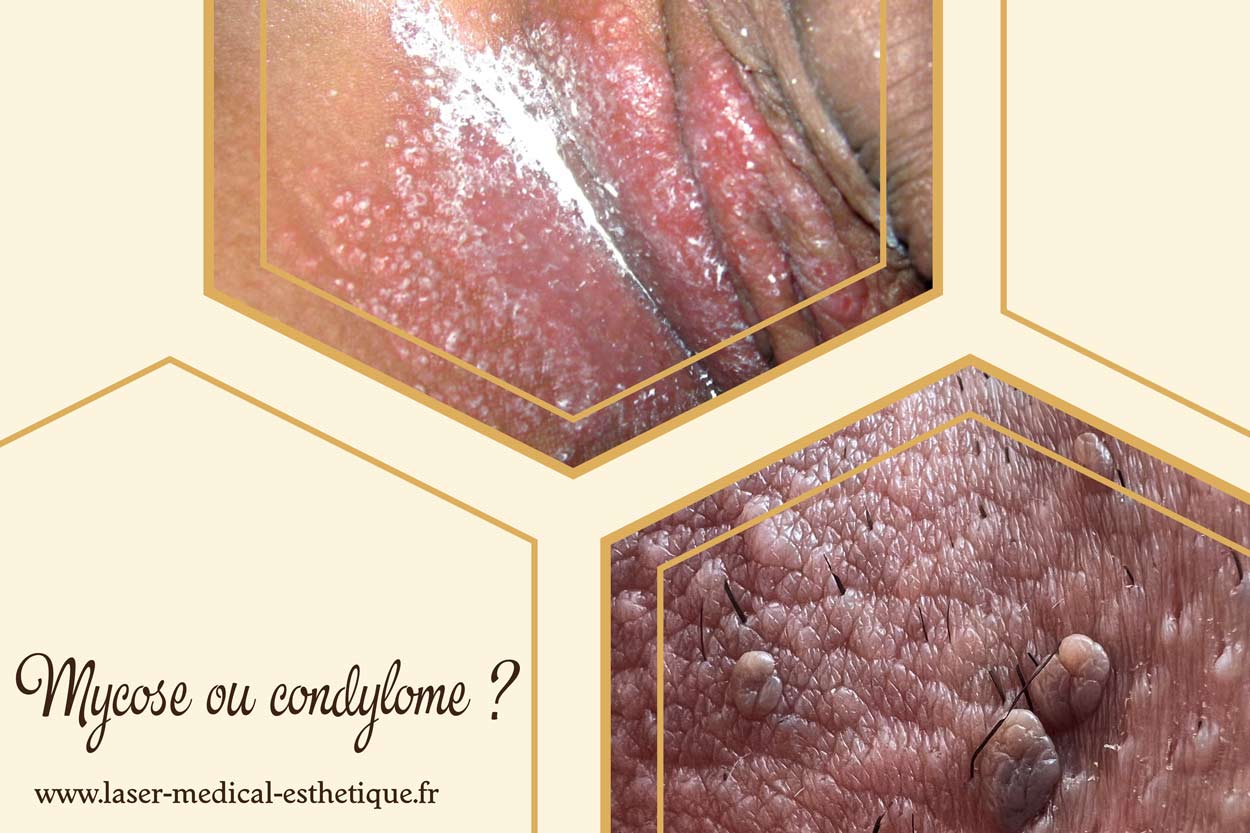 Crème imiquimod sans ordonnance