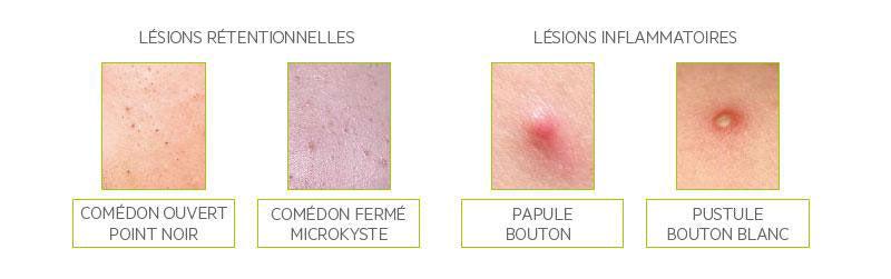 Isotrétinoïne pas cher