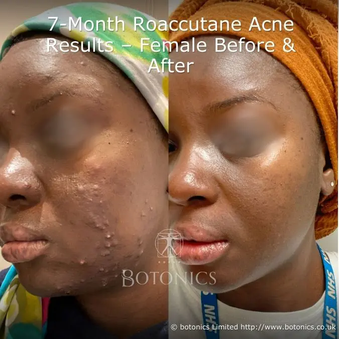 Roaccutane moins cher