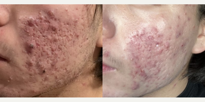 accutane moins cher