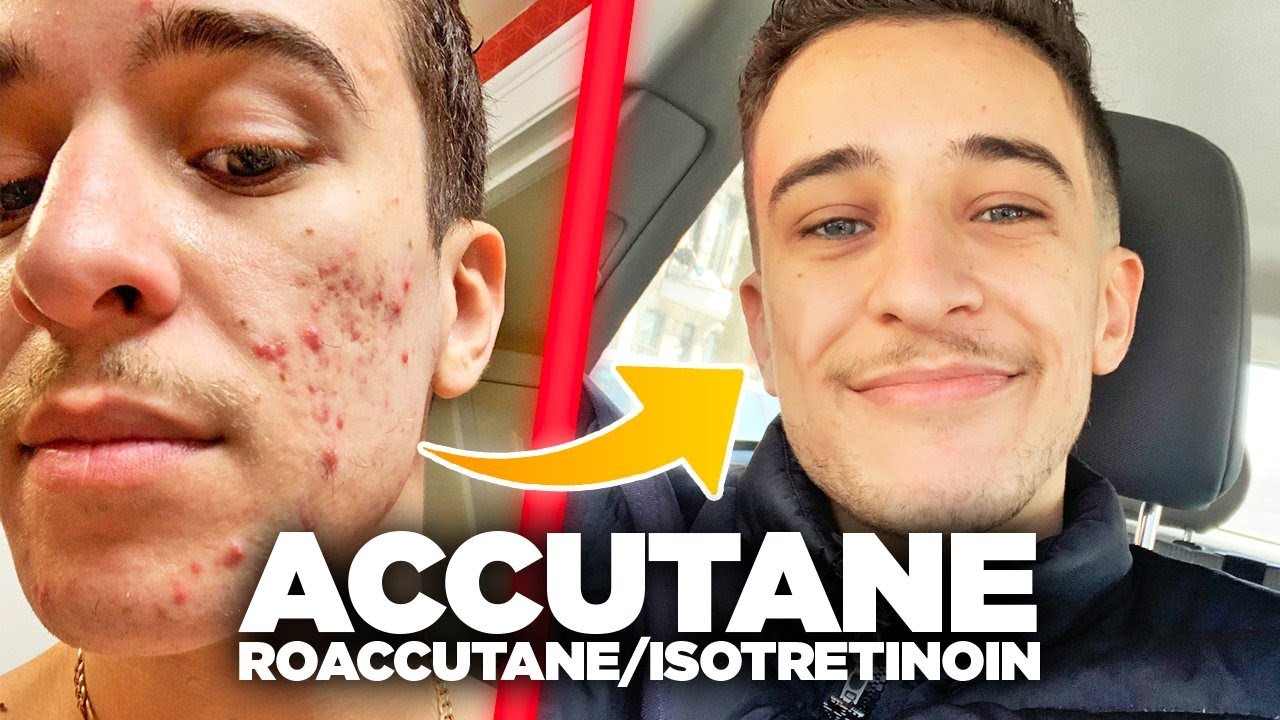 Ou Acheter Roaccutane