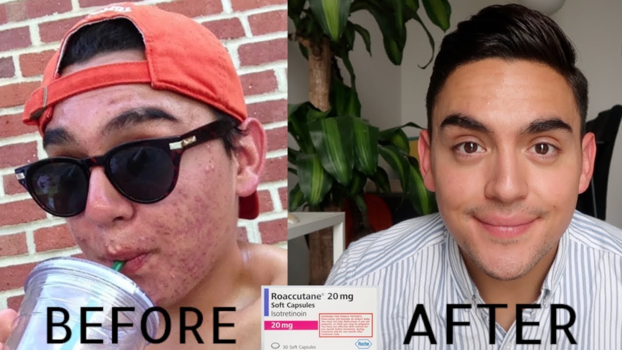 accutane 10 mg prix
