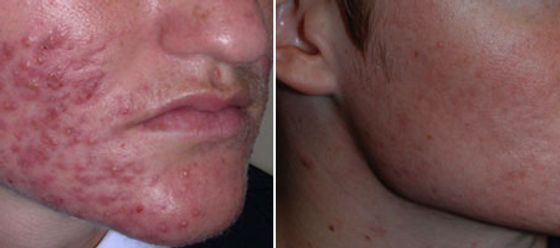 Accutane Acheter En Ligne