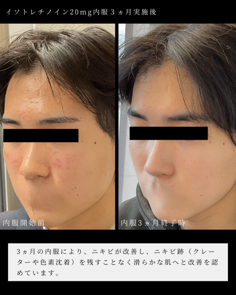 accutane france