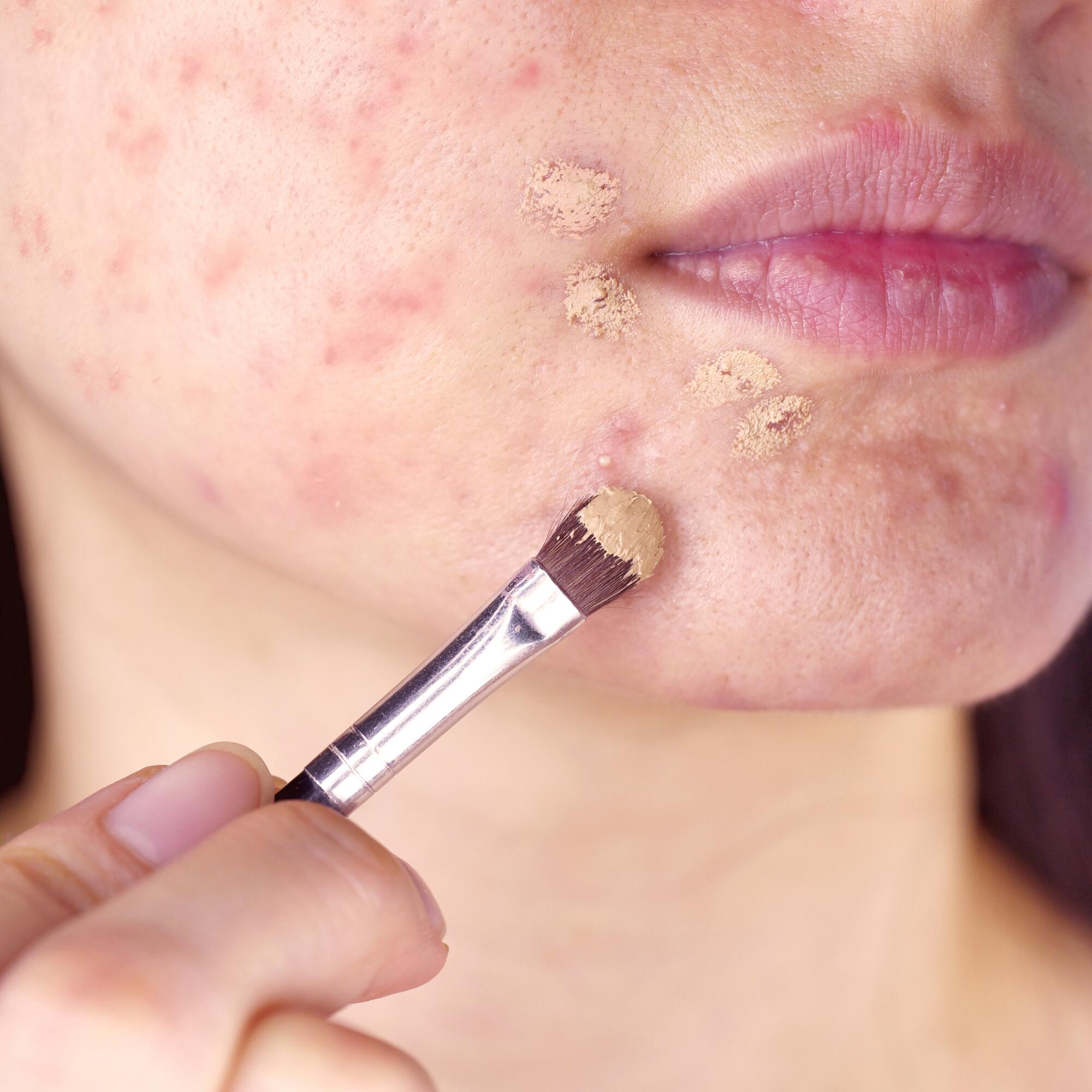 achat accutane en ligne