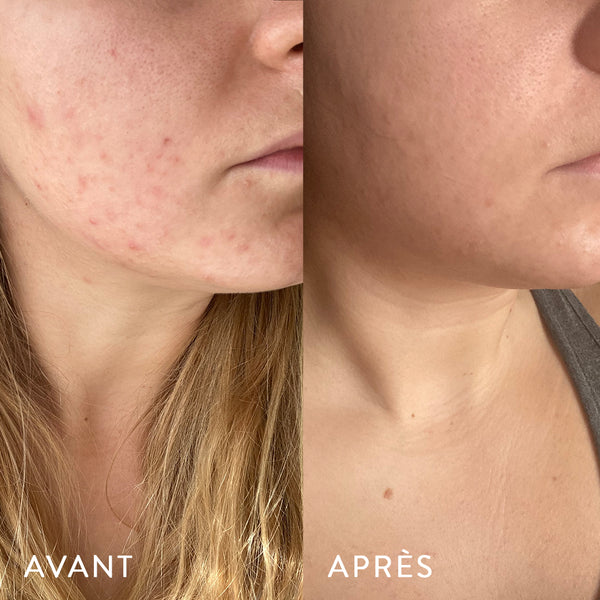 achat de accutane Achat De Accutane