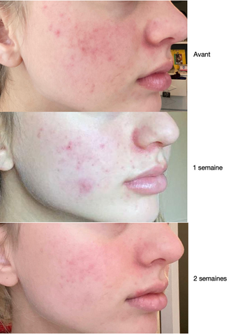 acheter accutane