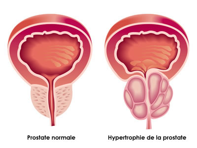 Acheter Proscar Générique