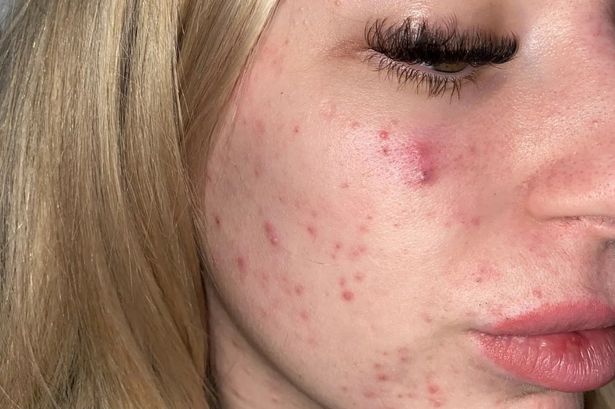 Acheter Roaccutane Gel