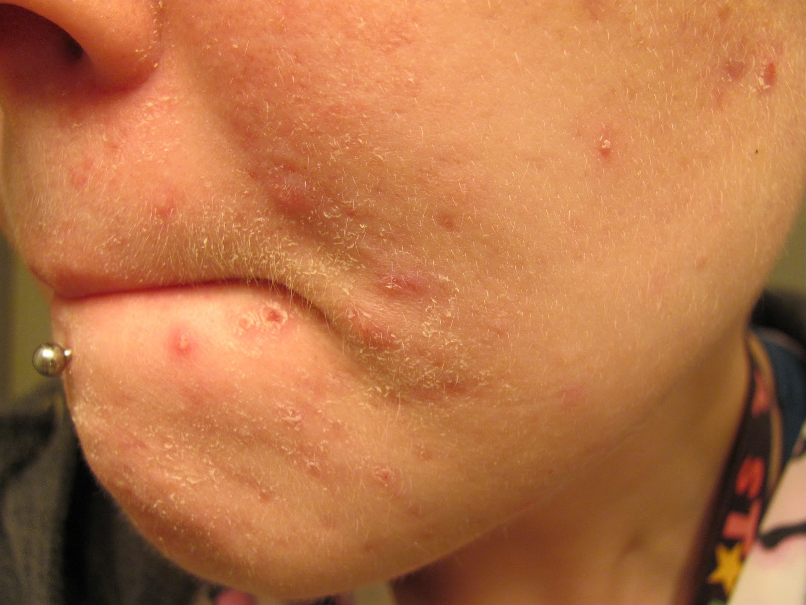 Accutane 10mg